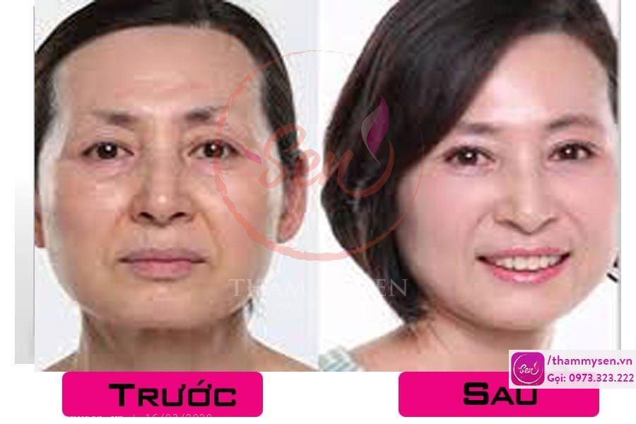 trẻ hóa bằng HIFU