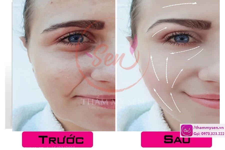 trẻ hóa bằng HIFU