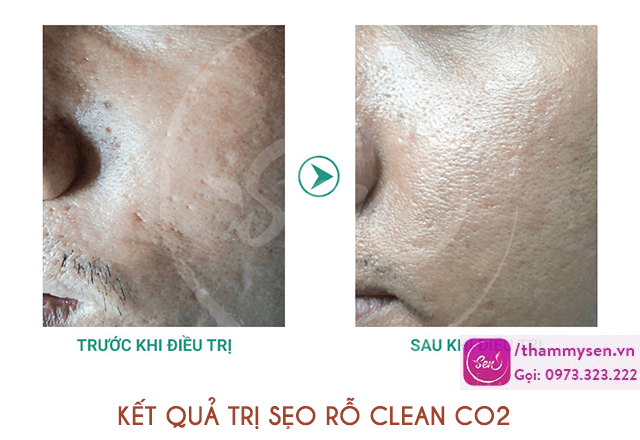 tri-seo-ro-seo-lom-bang-laser