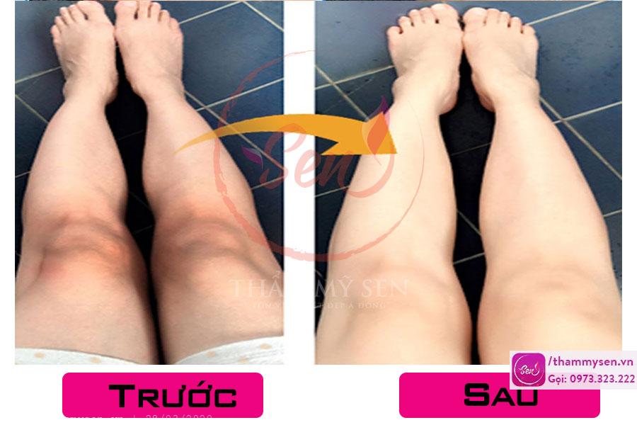 Hình ảnh trị thâm đầu gối