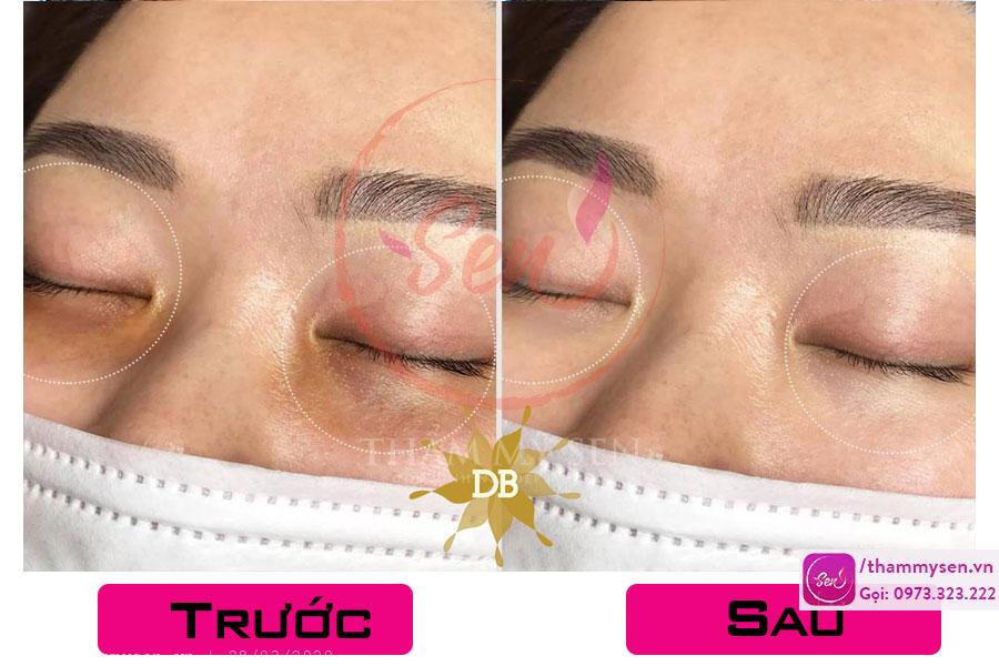 Kết quả trị thâm quầng mắt