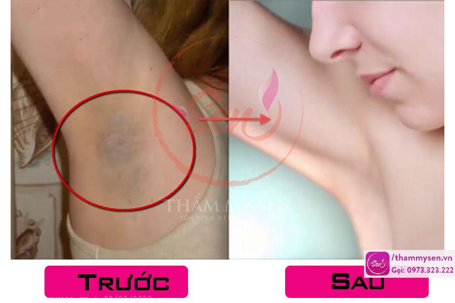 Kết quả trị thâm nách