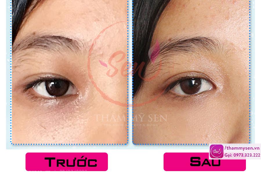 Kết quả trị thâm mắt