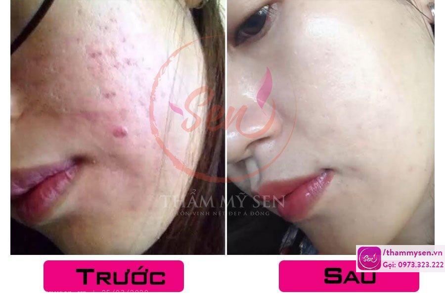 Trị mụn kháng khuẩn