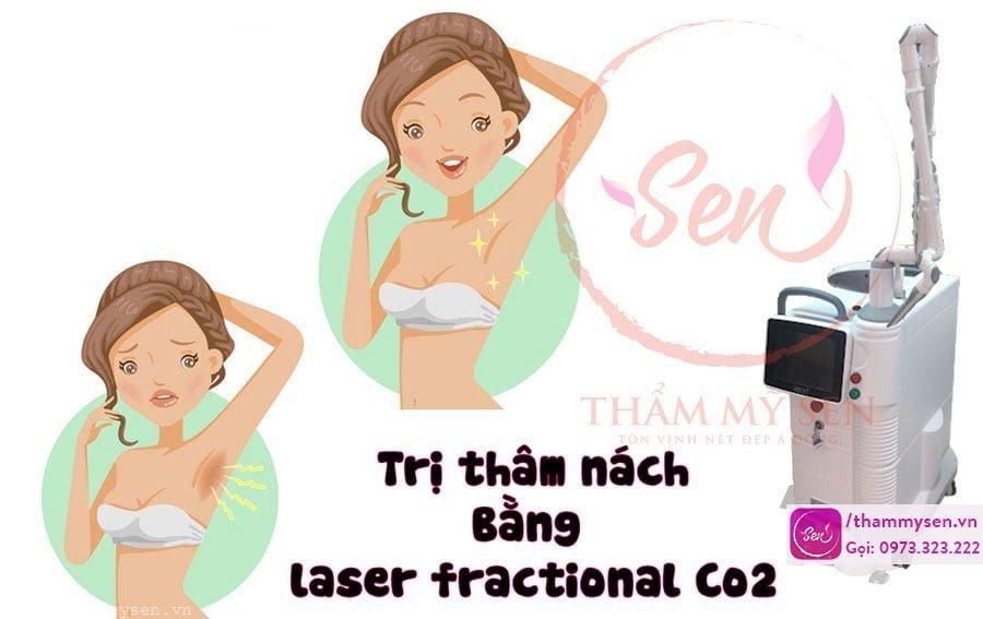 tri-tham-nach-bang-laser-fractional-co2