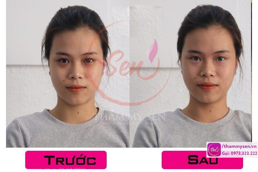 ket-qua-tri-tham-quang-mat