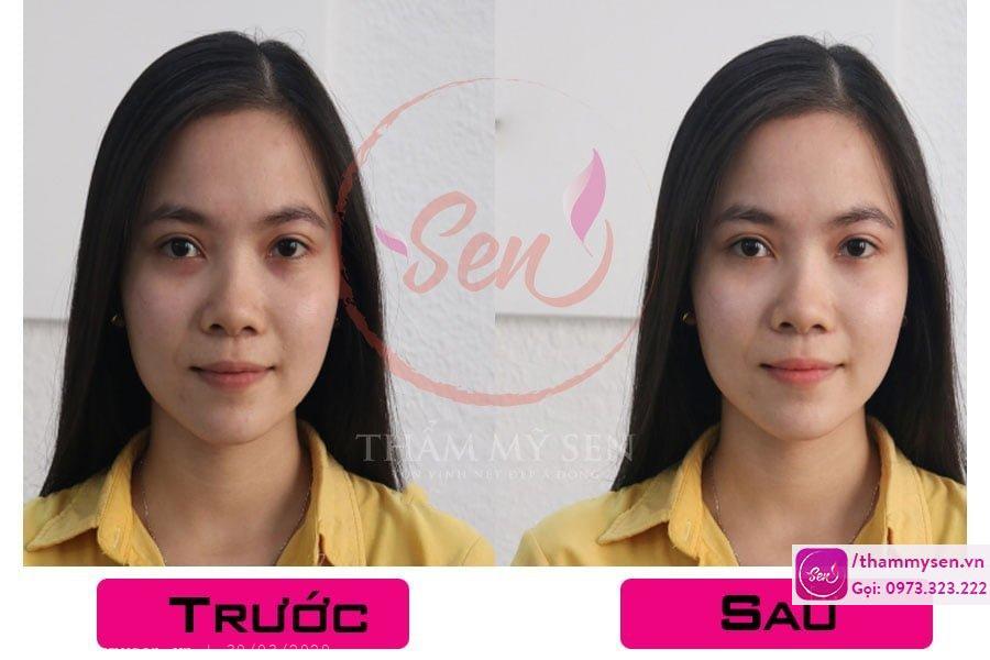 ket-qua-tri-tham-quang-mat