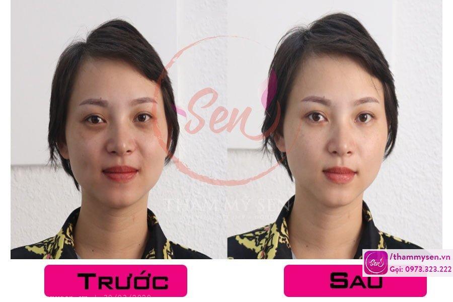 ket-qua-tri-tham-quang-mat