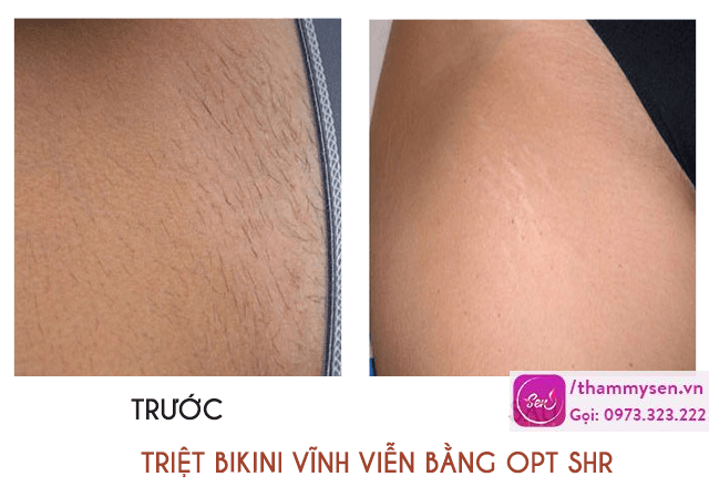 Triệt lông vĩnh viễn vùng bikini ảnh trước sau
