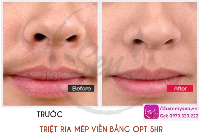 Triệt lông vĩnh viễn vùng ria mép ảnh trước sau