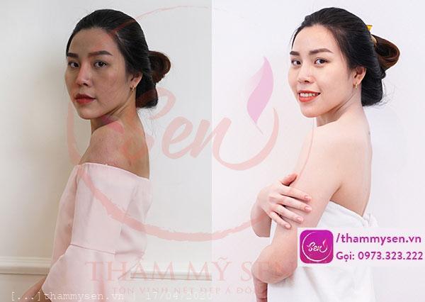 khách hàng tắm trắng lưng hiệu quả tại Thẩm mỹ Sen