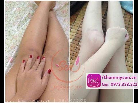 Hình ảnh khách hàng sau khi sử dụng liệu trình tắm trắng đùi