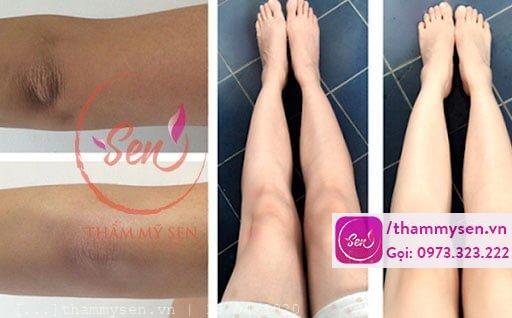 Hình ảnh khách hàng sau khi sử dụng liệu trình tắm trắng đùi