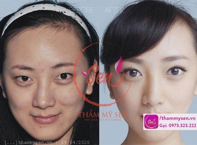 hình ảnh khách hàng sau khi sử liệu trình tắm trắng mặt