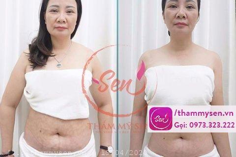 Khách hàng sau khi sử dụng liệu trình giảm béo với công nghệ Cavi Lipo