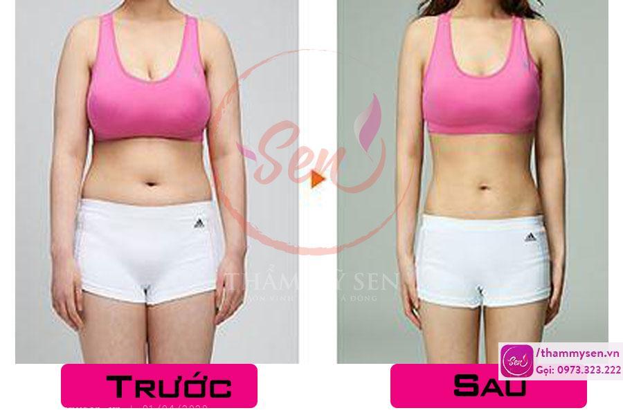 Khách hàng sử dụng liệu trình giảm mỡ bụng sau sinh 