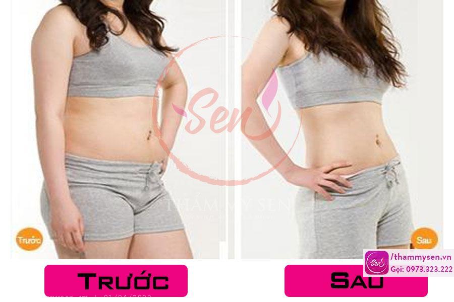 Hình ảnh trước và sau khi khách sử dụng liệu trình giảm béo bụng sau sinh 