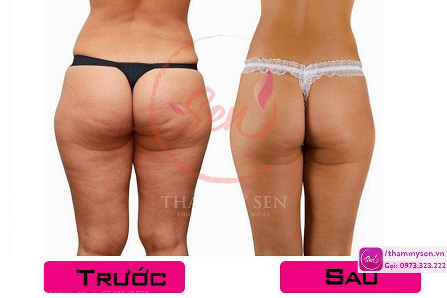Khách hàng giảm mỡ mông hiệu quả 