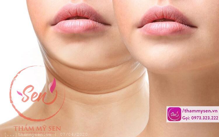 nguyên nhân gây mỡ nọng cằm