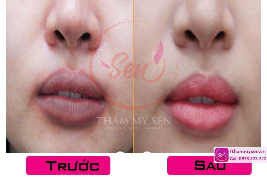Ket-qua-sau-lieu-trinh-tri-tham-moi-bang-laser