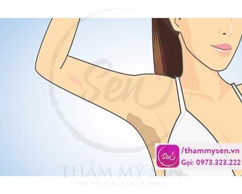 Lạm dụng việc Wax lông nách có thể dẫn tới bị hăm, thâm vùng da nách