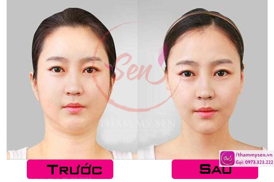 phương pháp giảm mỡ nọng cằm hiệu quả