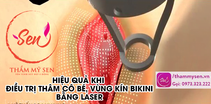 hieu-qua-tri-tham-co-be-vung-kin-bikini