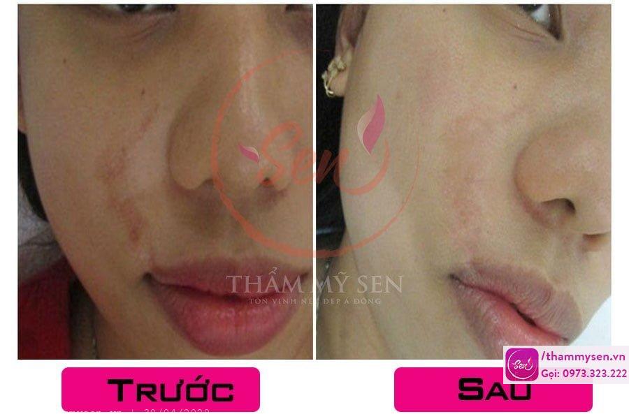 hinh-anh-truoc-sau-tri-seo-tham