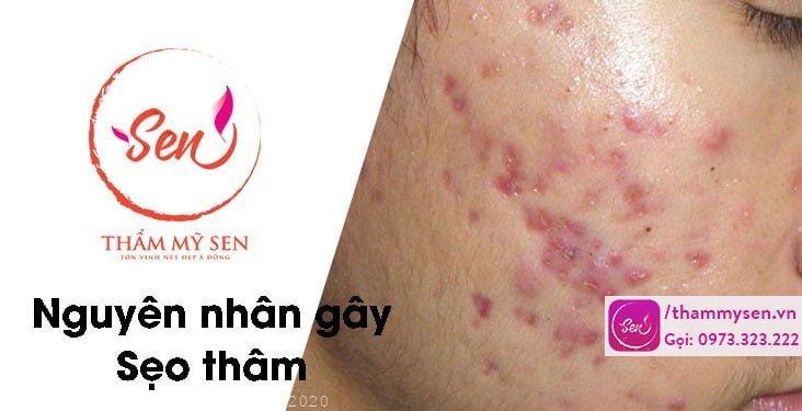 nguyen-nhan-gay-seo-tham