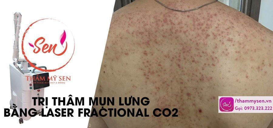 tri-tham-mun-lung-bang-laser-fractional-co2.jpg