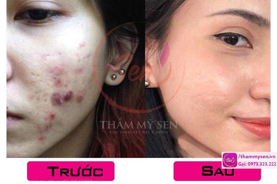 ket-qua-lieu-trinh-tri-seo-tham-bang-laser