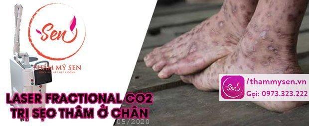 laser-fractional-co2-tri-tham-chan-o-chan