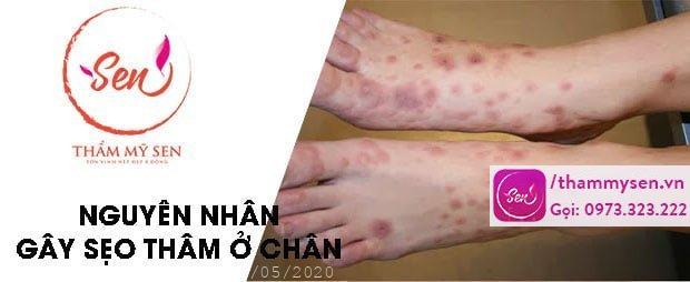 nguyen-nhan-seo-tham-o-chan