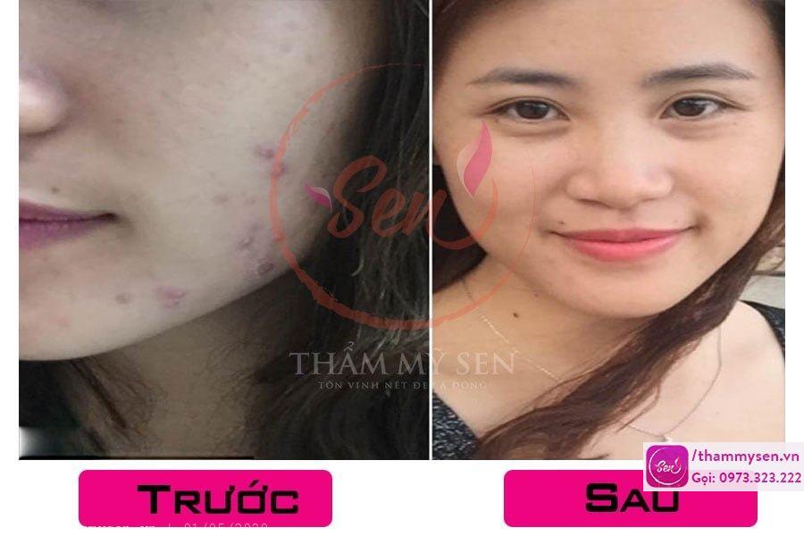 truoc-sau-khi-dieu-tri-seo-tham-bang-laser