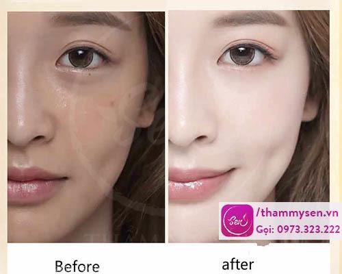 Kết quả cải thiện rõ rệt sau liệu trình ủ Face - White facial