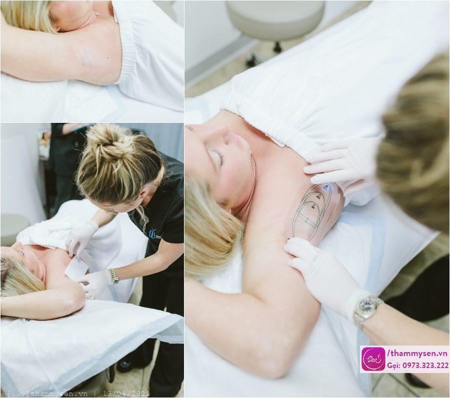 Một phương pháp điều trị hôi nách mà rất nhiều khách hàng yêu thích