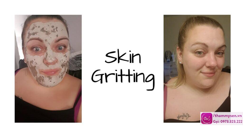 Skin gritting