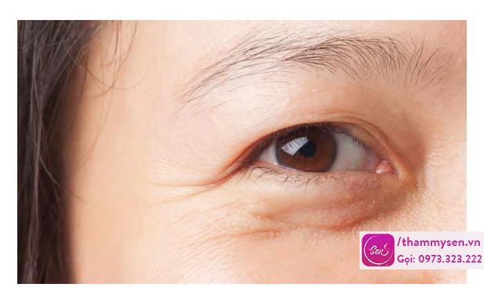 Xoa tan bọng mắt