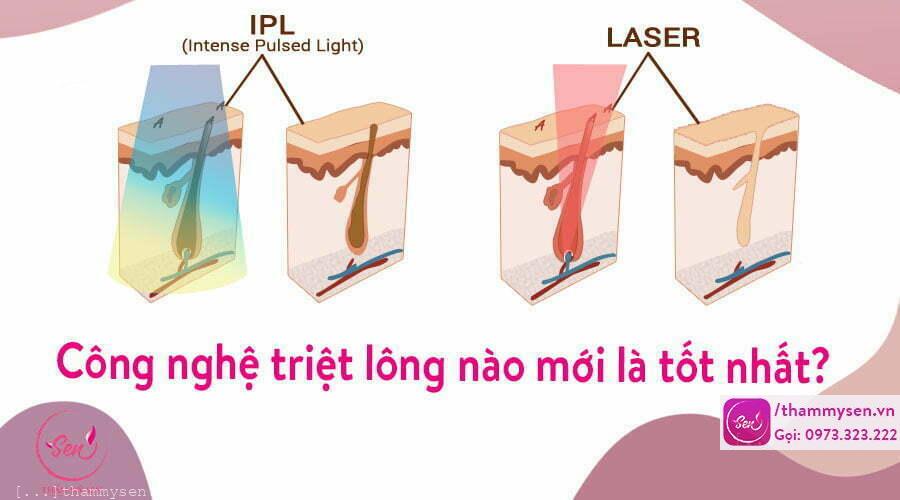 Cả Laser và IPL đều là công nghệ triệt lông tốt nhất ngày nay