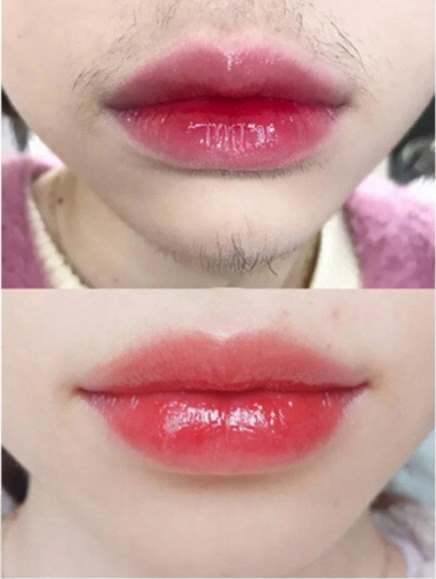Hình ảnh kết quả sau khi triệt ria mép của khách nữ 22 tuổi