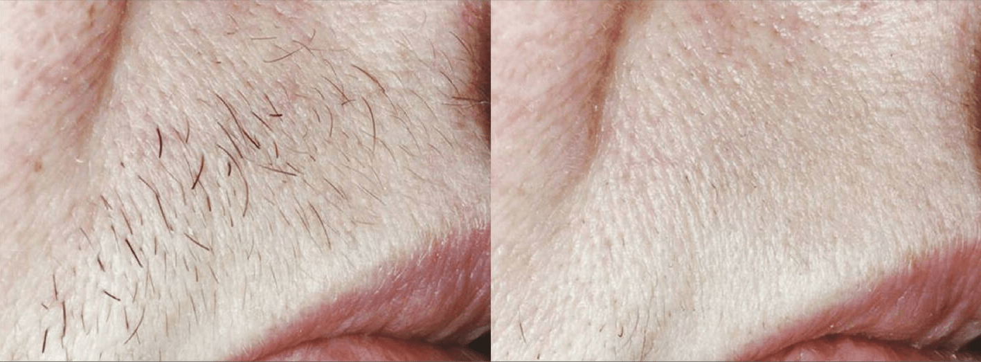 Hình ảnh trước và sau khi triệt ria mép ở khách hàng nữ trung tuổi