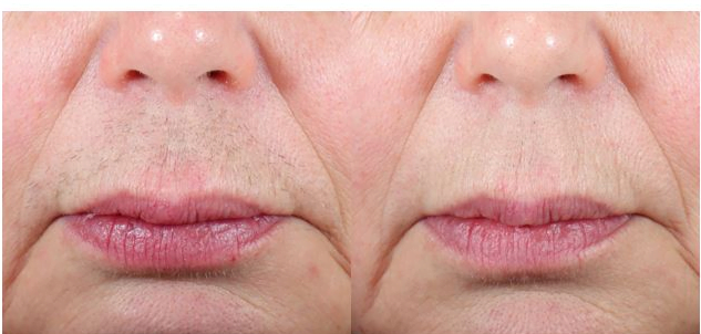 Hình ảnh râu mép trước khi triệt và sau khi triệt (với lông không quá sẫm màu) 
