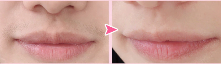 Hình ảnh râu mép trước khi triệt và sau khi triệt của khách hàng teen 16 tuổi